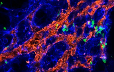 Gamma delta T cells can fight aggressive breast cancer
