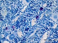 Mast cells have an important impact on the development of chronic myeloid leukemia