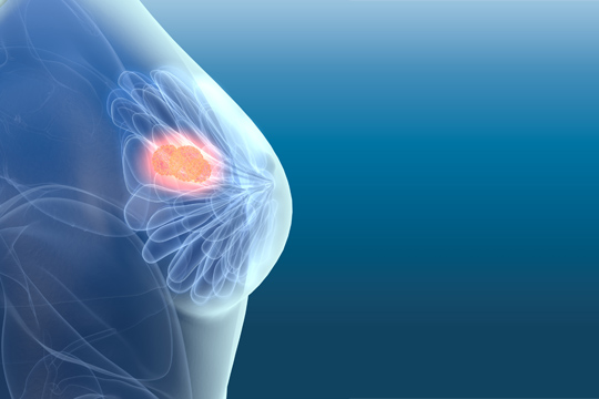 Symbolbild Brustkrebs: Grafische Darstellung einer weiblichen Brust mit Karzinom